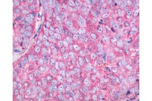 Anti-NMBR antibody IHC of human Ovary, Carcinoma.