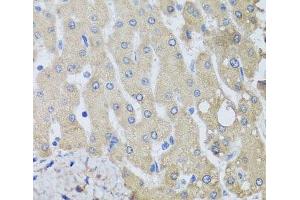 Immunohistochemistry of paraffin-embedded Human liver damage using NSF Polyclonal Antibody at dilution of 1:100 (40x lens). (NSF Antikörper)