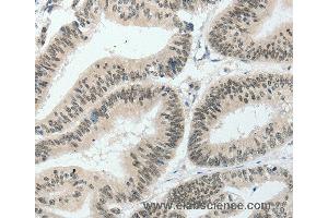 Immunohistochemistry of Human lung cancer using HNF1B Polyclonal Antibody at dilution of 1:80 (HNF1B Antikörper)
