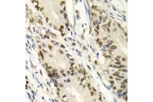 Immunohistochemistry of paraffin-embedded human gastric cancer using KPNA4 Antibody (ABIN5971058) at dilution of 1/100 (40x lens). (KPNA4 Antikörper)