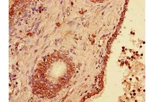 Immunohistochemistry of paraffin-embedded human prostate cancer using ABIN7174316 at dilution of 1:100 (USP33 Antikörper  (C-Term))