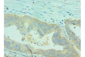 Immunohistochemistry of paraffin-embedded human colon cancer using ABIN7147898 at dilution of 1:100 (Claudin 2 Antikörper  (AA 30-230))