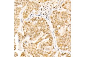 Immunohistochemistry of paraffin-embedded human colon carcinoma using Caspase-9 Rabbit mAb (ABIN6135366, ABIN7101390, ABIN7101391 and ABIN7101392) at dilution of 1:400 (40x lens).