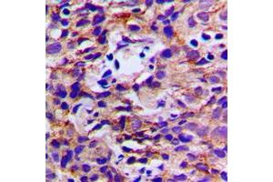 Immunohistochemical analysis of DDX3Y staining in human breast cancer formalin fixed paraffin embedded tissue section.