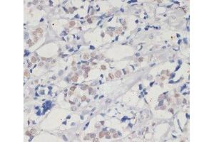Immunohistochemistry of paraffin-embedded Human breast cancer using DNMT1 Polyclonal Antibody at dilution of 1:200 (40x lens). (DNMT1 Antikörper)