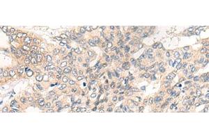 Immunohistochemistry of paraffin-embedded Human liver cancer tissue using CHRD Polyclonal Antibody at dilution of 1:40(x200) (Chordin Antikörper)