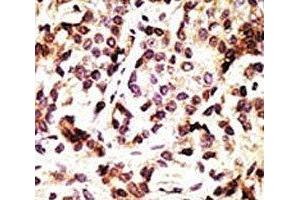 IHC analysis of FFPE human breast carcinoma tissue stained with the Beclin 1 antibody (Beclin 1 Antikörper  (AA 181-210))