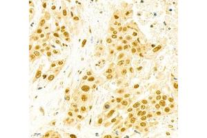 Immunohistochemistry of paraffin embedded human colon cancer using EFTUD2 (ABIN7073810) at dilution of 1: 2400 (400x lens) (EFTUD2 Antikörper)