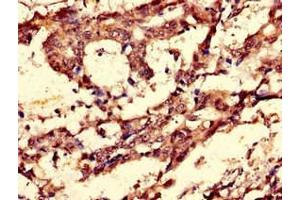 Immunohistochemistry of paraffin-embedded human gastric cancer using ABIN7148838 at dilution of 1:100 (Cyclin C Antikörper  (AA 240-283))
