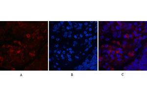 Immunofluorescence analysis of human lung cancer tissue. (MAP1LC3A Antikörper)