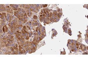 ABIN6277647 at 1/100 staining Human liver cancer tissue by IHC-P. (TACR1 Antikörper  (Internal Region))