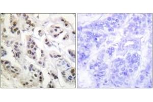 Immunohistochemistry analysis of paraffin-embedded human breast carcinoma tissue, using Lamin A/C (Ab-392) Antibody.