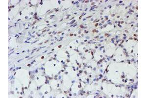 Immunohistochemical staining of paraffin-embedded Carcinoma of Human kidney tissue using anti-MLF1 mouse monoclonal antibody. (MLF1 Antikörper)
