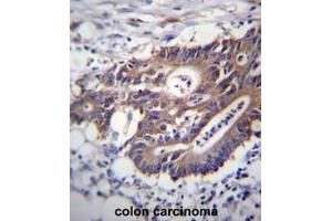 KRT12 Antibdy (C-term) immunohistochemistry analysis in formalin fixed and paraffin embedded human colon carcinoma followed by peroxidase conjugation of the secondary antibody and DAB staining. (KRT12 Antikörper  (C-Term))
