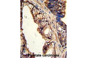 Formalin-fixed and paraffin-embedded human prostate carcinoma with TGM4 Antibody (Center), which was peroxidase-conjugated to the secondary antibody, followed by DAB staining. (TGM4 Antikörper  (Middle Region))