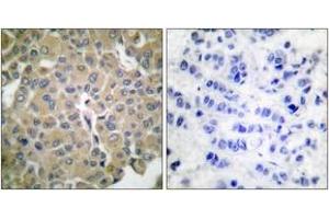 Immunohistochemistry analysis of paraffin-embedded human breast carcinoma tissue, using MART-1 Antibody. (MLANA Antikörper  (AA 41-90))