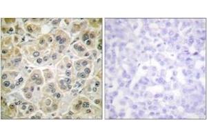 Immunohistochemistry analysis of paraffin-embedded human breast carcinoma tissue, using Vimentin Antibody. (Vimentin Antikörper  (AA 411-460))