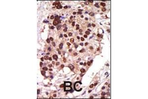 Formalin-fixed and paraffin-embedded human cancer tissue reacted with the primary antibody, which was peroxidase-conjugated to the secondary antibody, followed by AEC staining. (PRKD3 Antikörper  (AA 352-384))