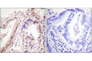 Immunohistochemistry analysis of paraffin-embedded human lung carcinoma tissue, using Estrogen Receptor-alpha (Ab-537) Antibody. (Estrogen Receptor alpha Antikörper  (AA 501-550))