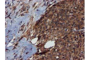 Immunohistochemical staining of paraffin-embedded Adenocarcinoma of Human breast tissue using anti-C1S mouse monoclonal antibody. (C1S Antikörper)