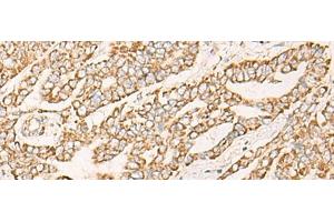 Immunohistochemistry of paraffin-embedded Human liver cancer tissue using COX6C Polyclonal Antibody at dilution of 1:25(x200) (COX6C Antikörper)