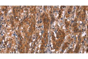 Immunohistochemistry of paraffin-embedded Human gastric cancer tissue using GPHN Polyclonal Antibody at dilution 1:30 (Gephyrin Antikörper)