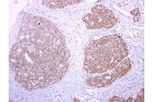 IHC-P Image tPA antibody detects tPA protein at cytoplasm on human colon carcinoma by immunohistochemical analysis. (PLAT Antikörper)