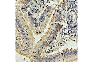 Immunohistochemical analysis of IL-27 staining in human colon cancer formalin fixed paraffin embedded tissue section. (IL-27 Antikörper)