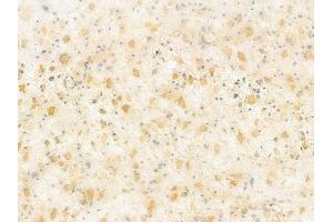 Ephrin B1/B2/B3 Antibody at 1/100 staining human astrocytoma by IHC-P. (Ephrin B1/B2/B3 (EFNB1/2/3) Antikörper)