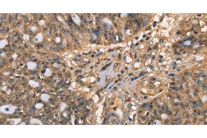 Immunohistochemistry of paraffin-embedded Human ovarian cancer tissue using HK3 Polyclonal Antibody at dilution 1:40
