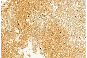 ABIN6265507 and ABIN6272873 at 1/100 staining Human esophageal cancer by IHC-P. (TCTN1 Antikörper  (N-Term))