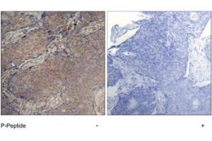 Imunohistochemical analysis of paraffin-embedded human breast carcinoma tissue, using MYL2 (phospho S19) polyclonal antibody . (MYL12A Antikörper  (pSer18))