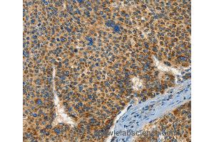 Immunohistochemistry of Human breast cancer using IFT74 Polyclonal Antibody at dilution of 1:60 (IFT74 Antikörper)