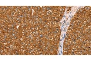 Immunohistochemistry of paraffin-embedded Human breast cancer tissue using ABCC8 Polyclonal Antibody at dilution 1:40 (ABCC8 Antikörper)