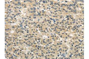 The image on the left is immunohistochemistry of paraffin-embedded Human liver cancer tissue using ABIN7193043(WDR91 Antibody) at dilution 1/20, on the right is treated with synthetic peptide. (WDR91 Antikörper)