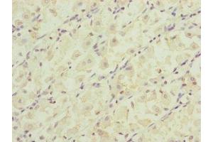 Immunohistochemistry of paraffin-embedded human gastric cancer using ABIN7164323 at dilution of 1:100 (RARS2 Antikörper  (AA 17-340))