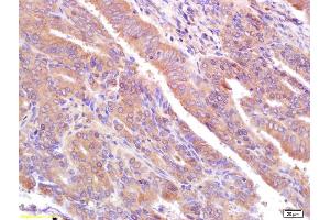 Formalin-fixed and paraffin embedded human breast cancer labeled with Rabbit Anti CA153/EMA/Mucin 1 Polyclonal Antibody, Unconjugated (ABIN673824) at 1:200 followed by conjugation to the secondary antibody and DAB staining (MUC1 Antikörper  (AA 1051-1255))