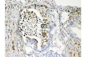 IHC testing of FFPE human intestinal cancer tissue with TMEM107 antibody at 1ug/ml. (TMEM107 Antikörper  (AA 22-57))
