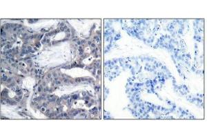 Immunohistochemical analysis of paraffin-embedded human breast carcinoma tissue using MEK-2(Phospho-Thr394) Antibody(left) or the same antibody preincubated with blocking peptide(right). (MEK2 Antikörper  (pThr394))
