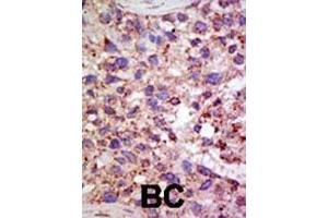 Formalin-fixed and paraffin-embedded human cancer tissue reacted with the primary antibody, which was peroxidase-conjugated to the secondary antibody, followed by AEC staining. (USP11 Antikörper  (N-Term))