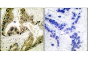 Immunohistochemistry analysis of paraffin-embedded human lung carcinoma tissue, using HDAC10 Antibody. (HDAC10 Antikörper  (AA 10-59))