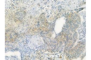 ABIN6259034 and ABIN6275060 at 1/100 staining human cervical carcinoma by IHC-P. (DHODH Antikörper  (Internal Region))