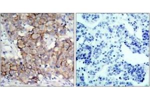 Immunohistochemistry analysis of paraffin-embedded human breast carcinoma, using HER2 (Phospho-Tyr877) Antibody. (ErbB2/Her2 Antikörper  (pTyr877))