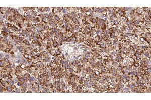 ABIN6279609 at 1/100 staining Human liver cancer tissue by IHC-P. (CHRNB3 Antikörper  (Internal Region))