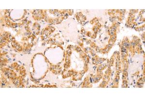 Immunohistochemistry of paraffin-embedded Human thyroid cancer using NAMPT Polyclonal Antibody at dilution of 1:30 (NAMPT Antikörper)