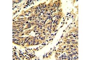 IHC analysis of FFPE human lung carcinoma stained with WNT4 antibody. (WNT4 Antikörper  (AA 242-269))