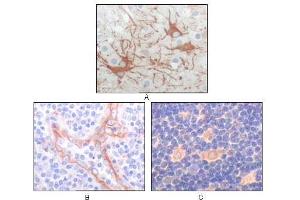 Immunohistochemical analysis of paraffin-embedded human cerebrum tumor (A), endothelium of vessel (B), lymphocyte of thymus(C), showing cytoplasmic localization using FES antibody with DAB staining. (FES Antikörper)