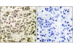Immunohistochemistry analysis of paraffin-embedded human breast carcinoma tissue, using HDAC3 Antibody. (HDAC3 Antikörper  (AA 379-428))