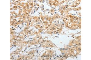 Immunohistochemistry of Human lung cancer using BPIFB2 Polyclonal Antibody at dilution of 1:45 (BPIL1 Antikörper)