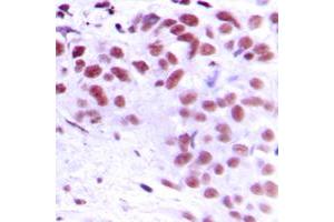 Immunohistochemical analysis of MEOX2 staining in human breast cancer formalin fixed paraffin embedded tissue section. (MEOX2 Antikörper  (Center))